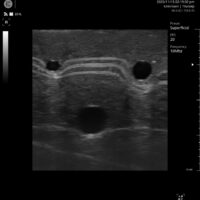 Internal Ultrasound Image (2)