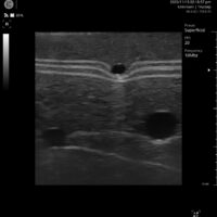 Internal Ultrasound Image